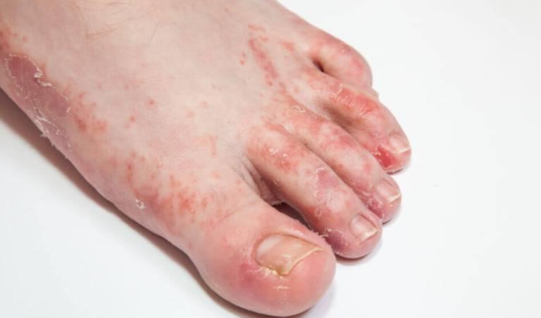 Guía Completa sobre Hongos Patógenos: Identificación, Prevención y Tratamiento 7 pie de atleta